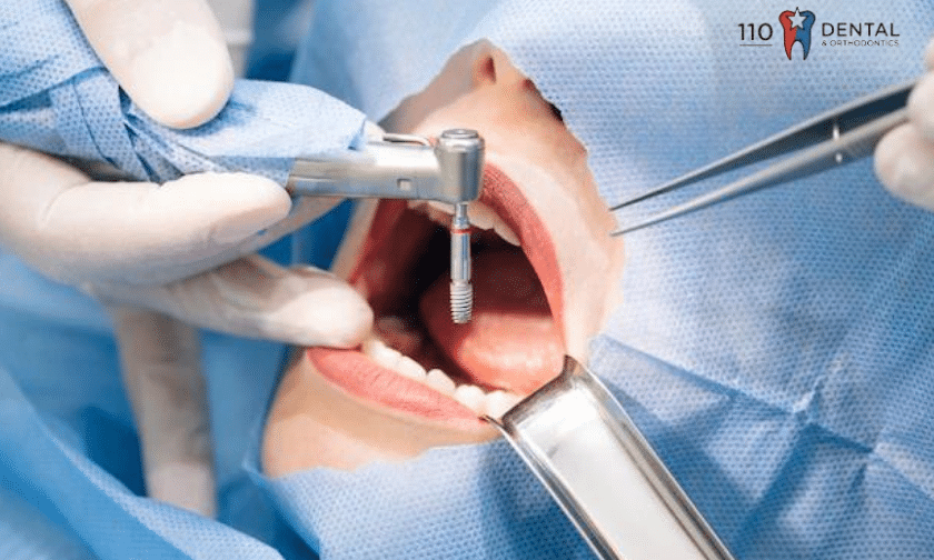 What Are The Top 10 Advantages Of Dental Implants?