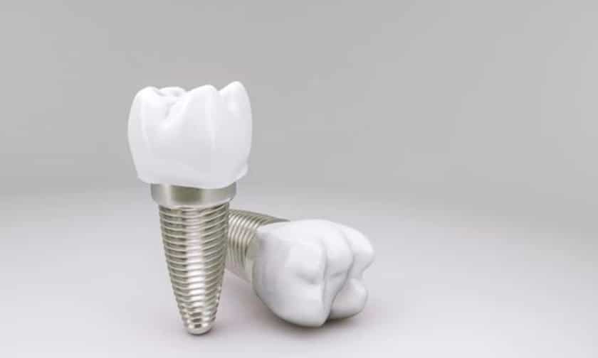 Dental Implants in Whitehouse – Picking Your Best Option