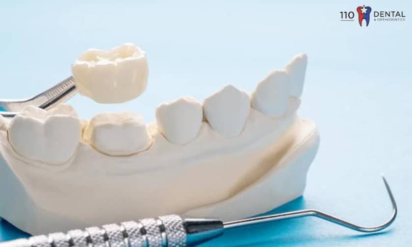 Everything You Need to Know About Dental Crowns