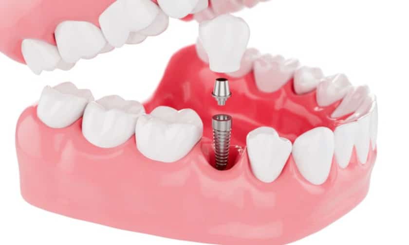 What to Expect from Dental Implants in Whitehouse?