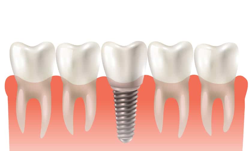 What You Need To Know About Dental Implants Before Getting One