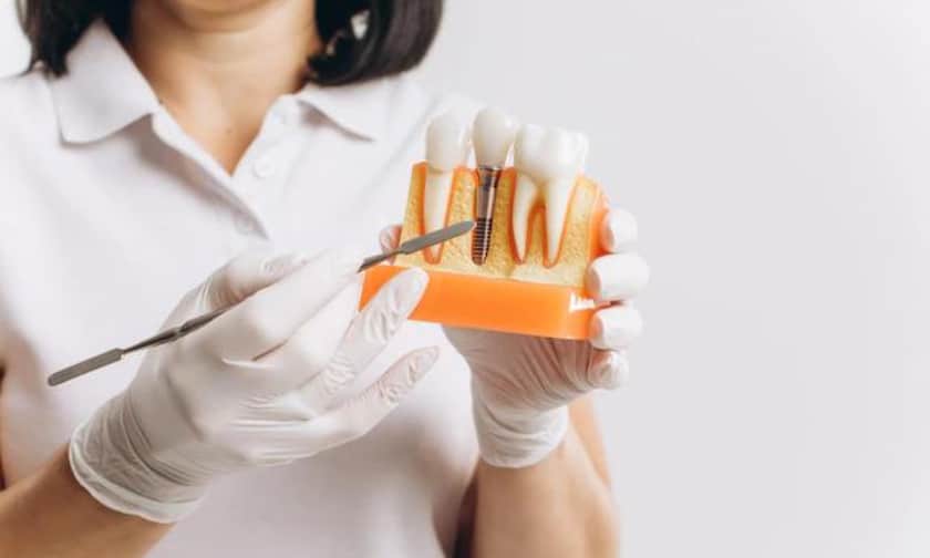 How Much Do Dental Implants Cost?