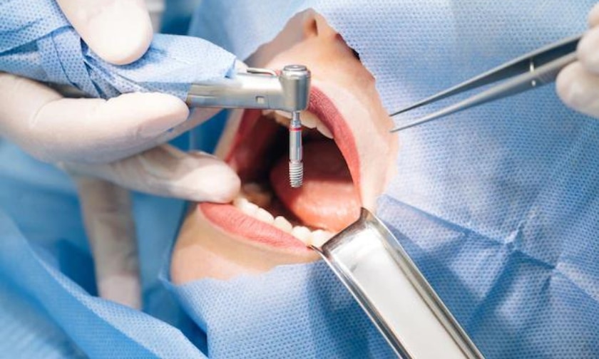 5 Reasons To Get Your Dental Implants
