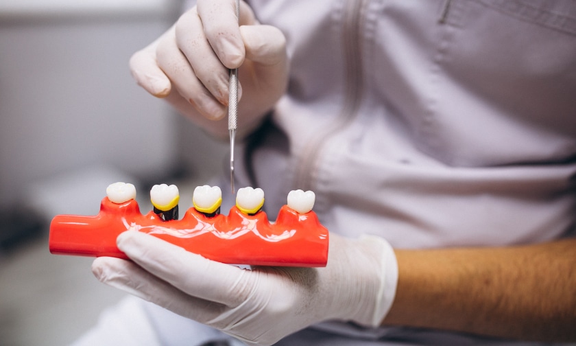 What to Expect When Getting Dental Crowns