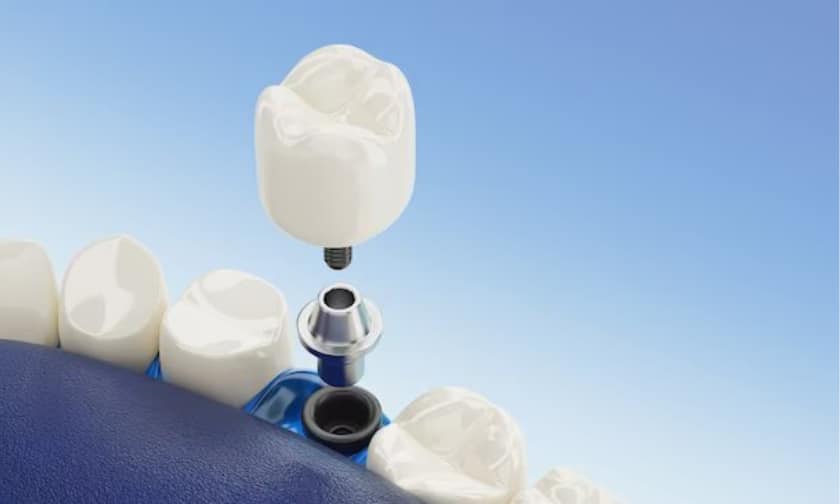 What You Need To Know About Dental Implants