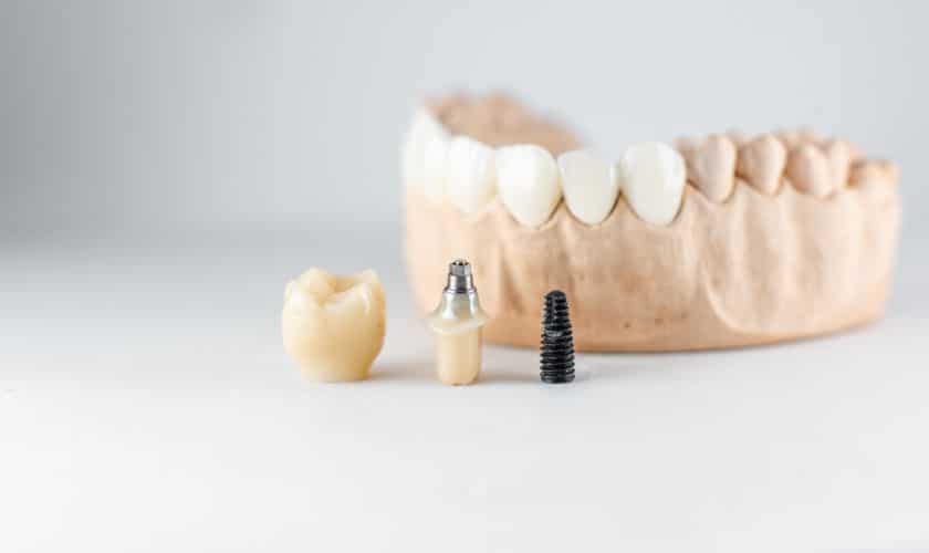 6 Symptoms You Need To Look Out For When Getting Implants