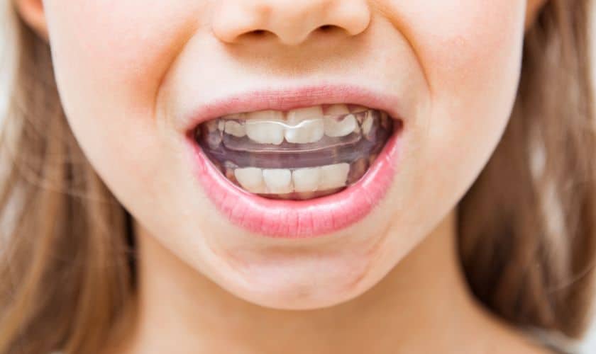 The Different Orthodontic Appliances Used In Early Treatment