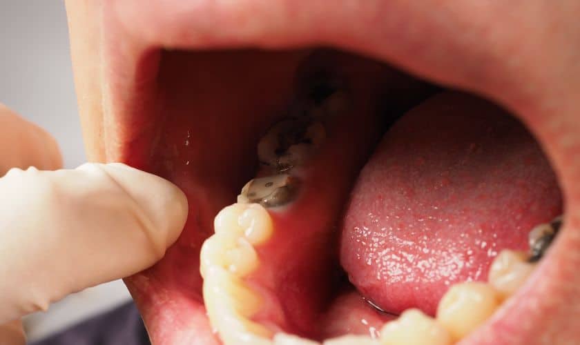 How To Care For Your Tooth After A Root Canal?