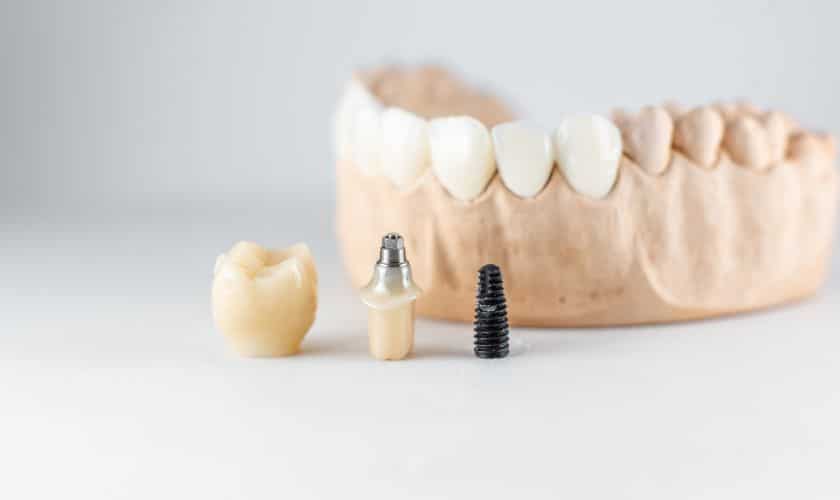 The Secret to a Confident Smile: Why Dental Implants Are Worth the Investment