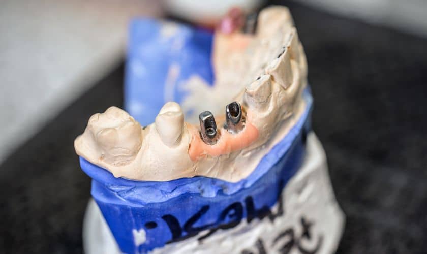 Implant Dentistry Evolution: From Single Tooth Replacement To Full Arch Solutions
