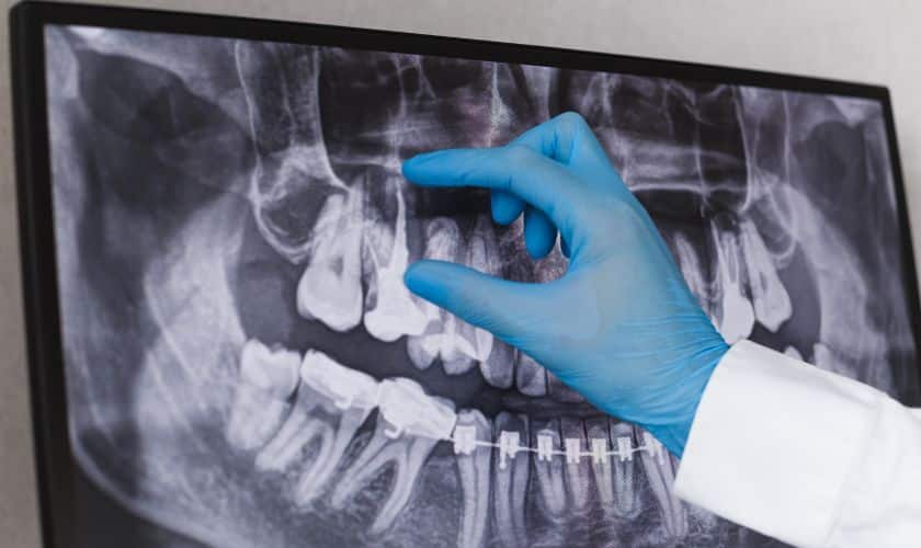 Understanding Root Canal Therapy: Myths vs. Facts