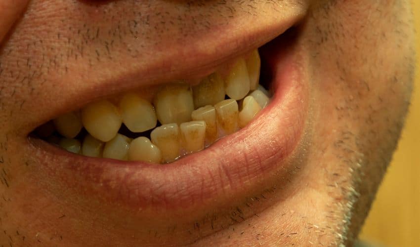 Malocclusion problem