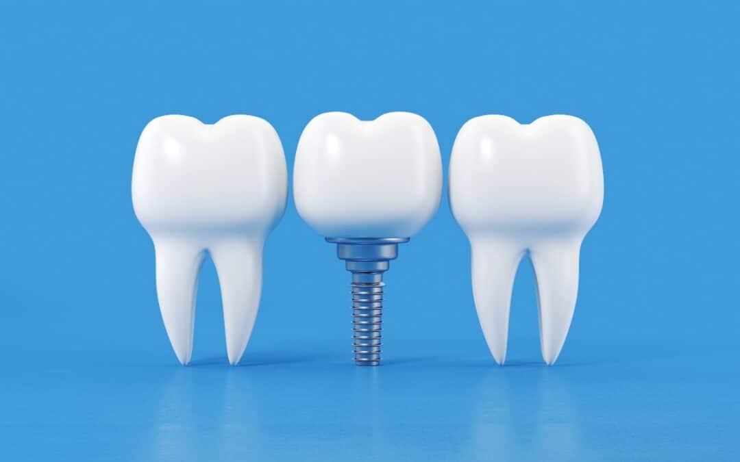 Longevity of Dental Implants: A Comprehensive Guide