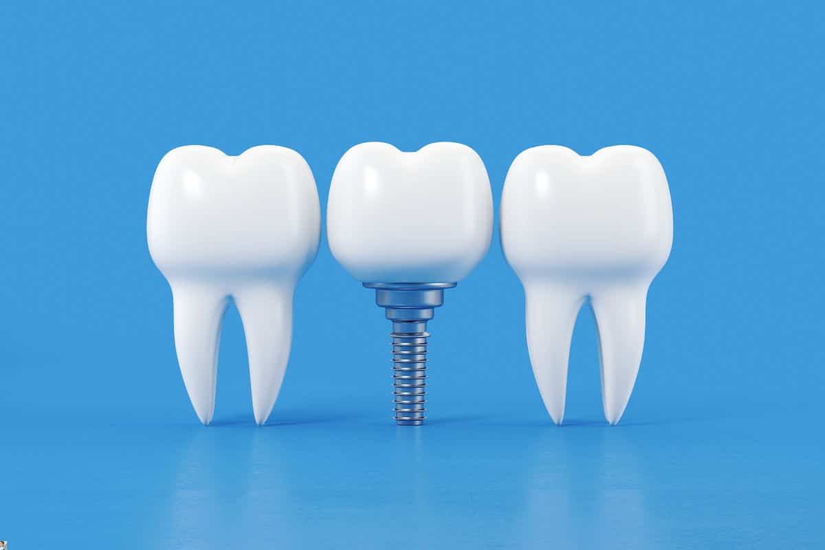 Longevity of Dental Implants: A Comprehensive Guide