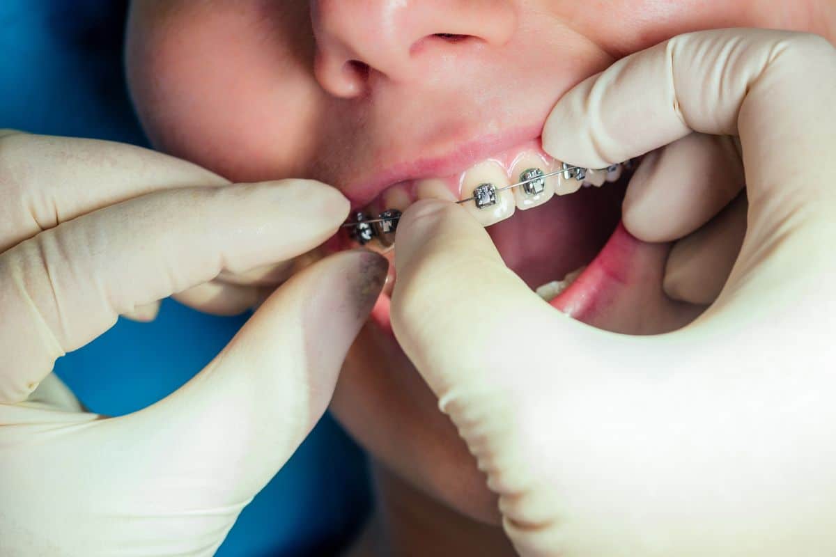 Do Braces Hurt? How to Manage Pain and Discomfort During Orthodontic Treatment