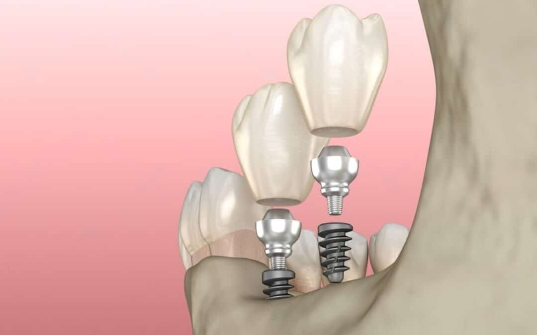 Mini Dental Implants vs. Traditional Implants: Which is Right for You?