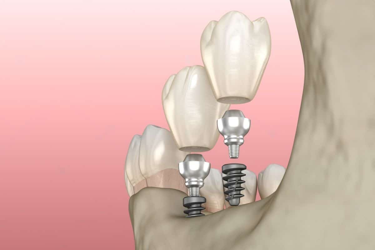 Mini Dental Implants vs. Traditional Implants: Which is Right for You?