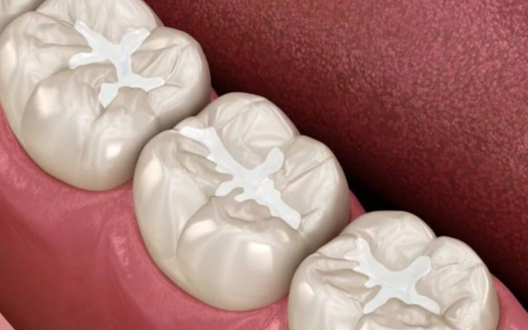 What Are Dental Sealants? Understanding Their Role in Preventing Cavities