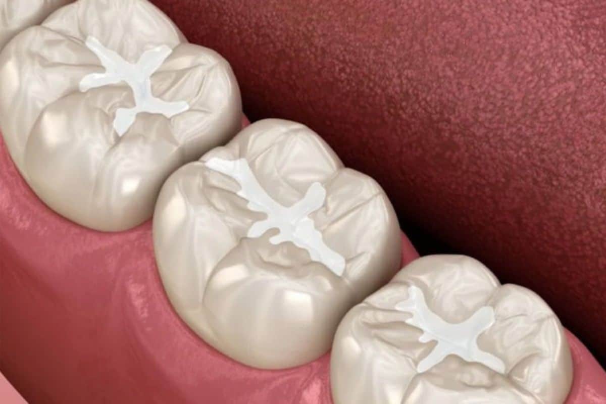 What Are Dental Sealants? Understanding Their Role in Preventing Cavities