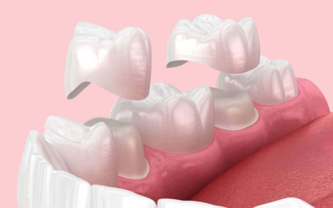 The Durability of Different Dental Crowns