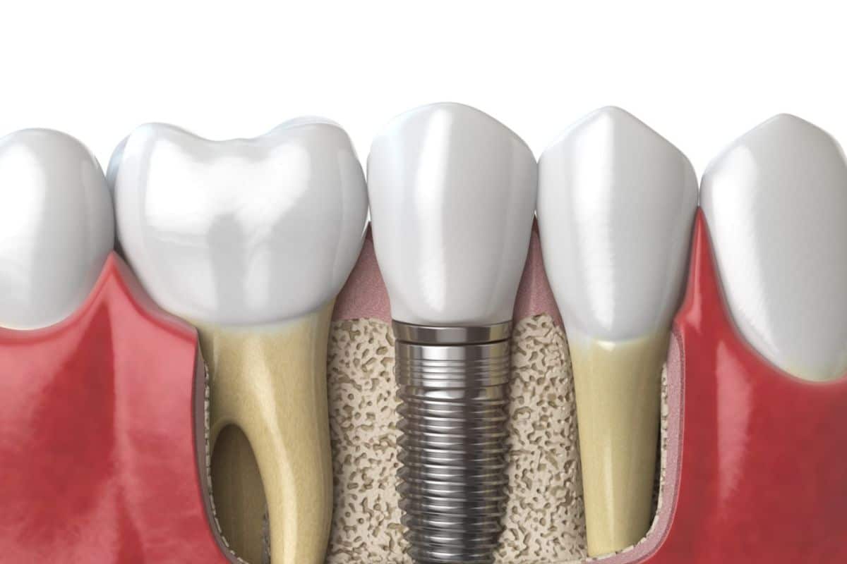 Can Dental Implants Cause Sinus Problems? What You Need to Know