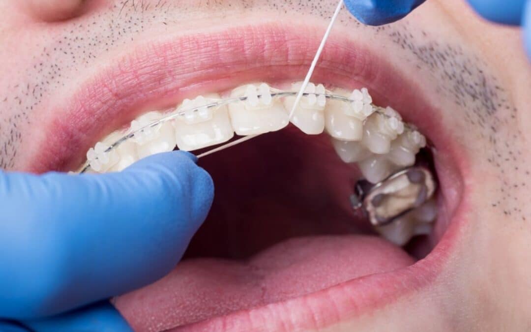 Removing Stains from Clear Braces: Possible Solutions