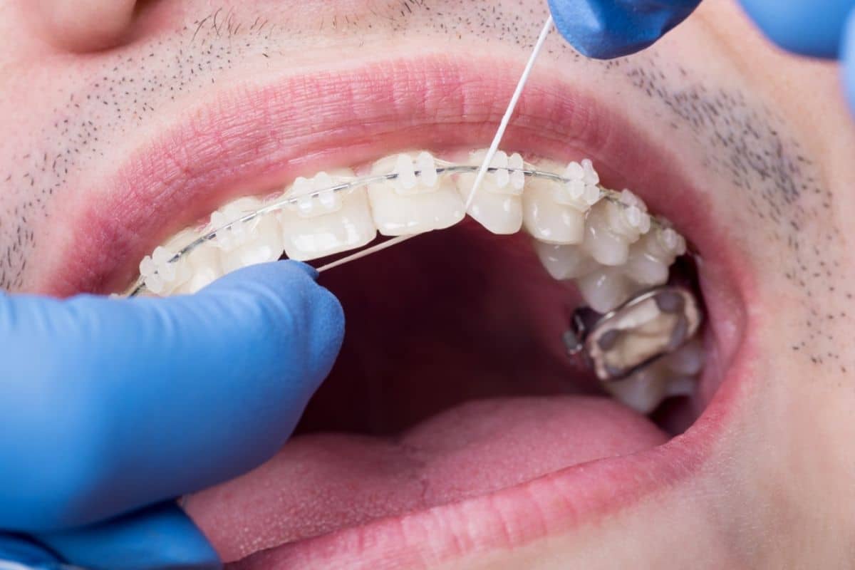 Removing Stains from Clear Braces: Possible Solutions