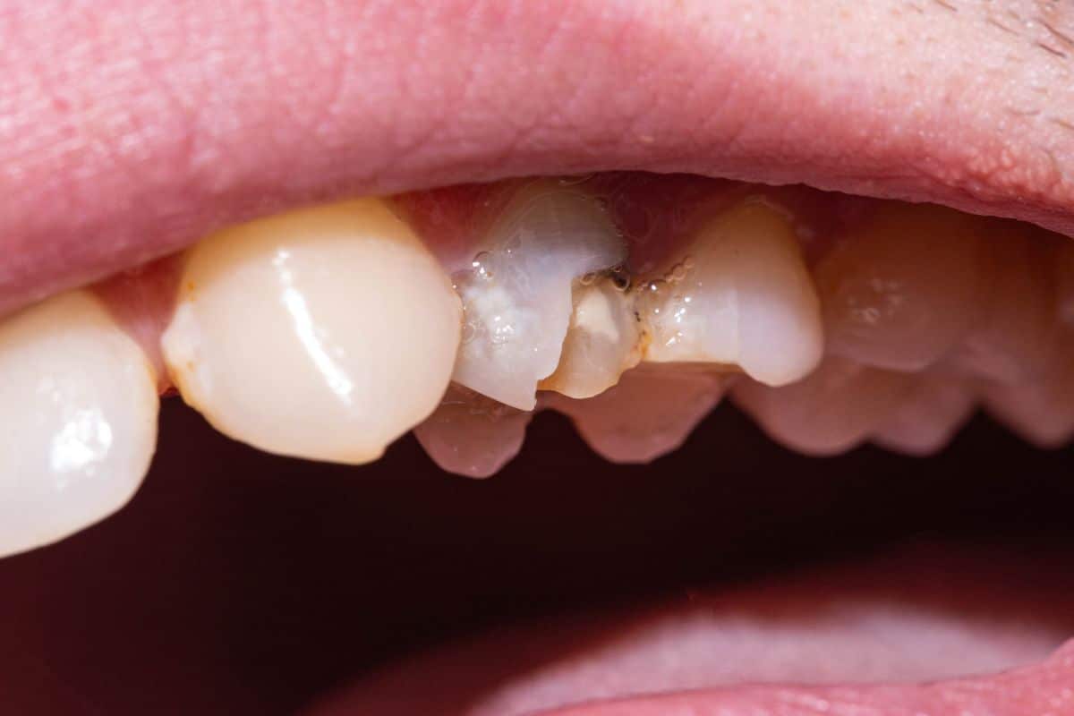 Understanding Enamel Erosion: Why It Occurs and How to Prevent It?