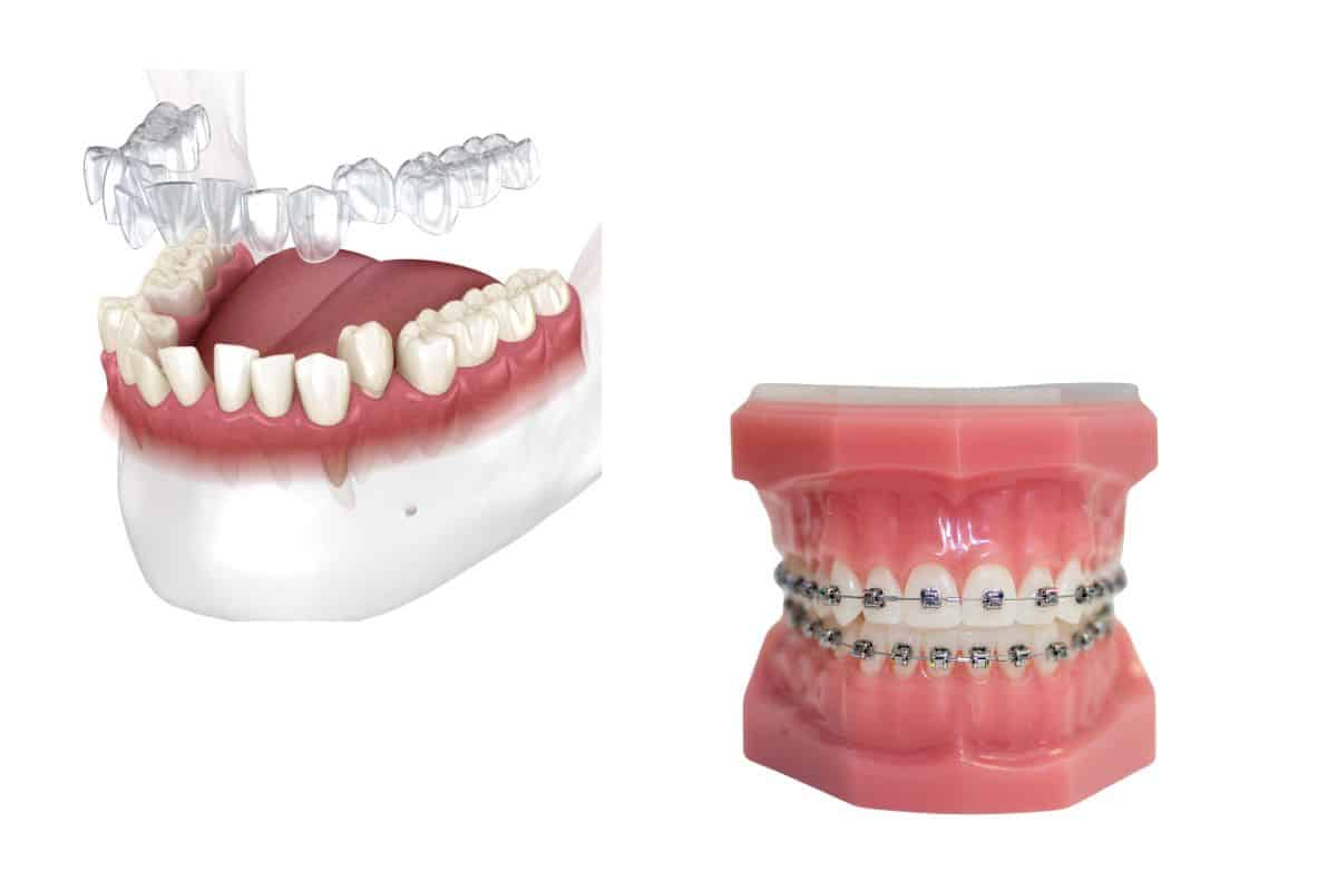 Invisalign vs. Braces: Treatment Times and Effectiveness
