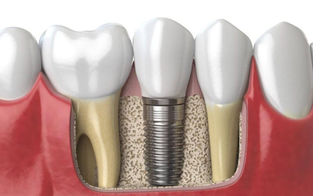 Dental Implants for Teens After Sports Injuries: A Long-Term Solution