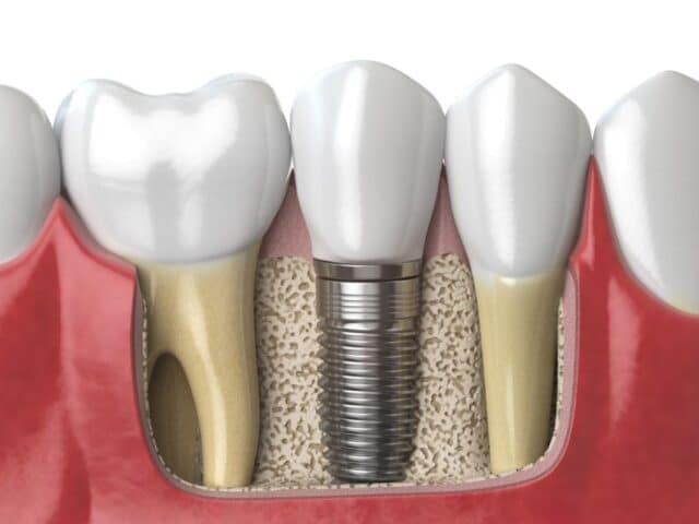 Dental Implants for Teens After Sports Injuries: A Long-Term Solution
