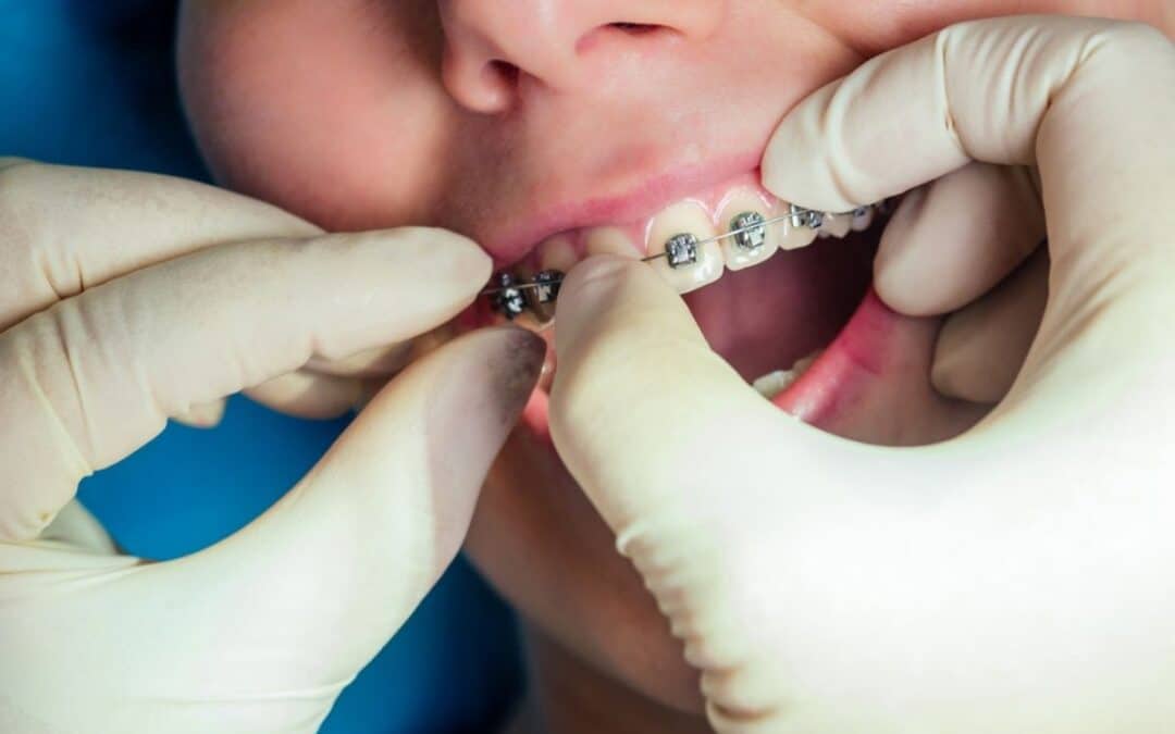 How to Know If Your Braces Need Emergency Repair