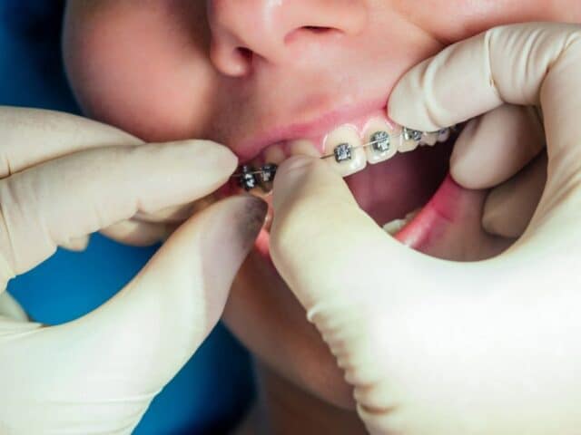How to Know If Your Braces Need Emergency Repair