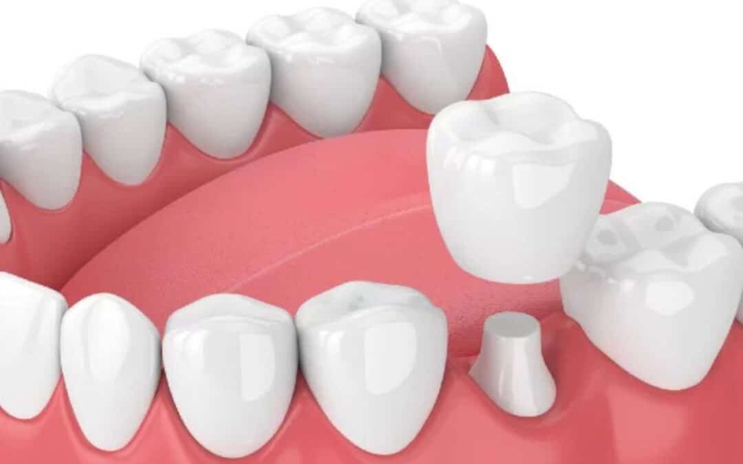 How Do Dental Crowns Work to Protect Your Teeth?