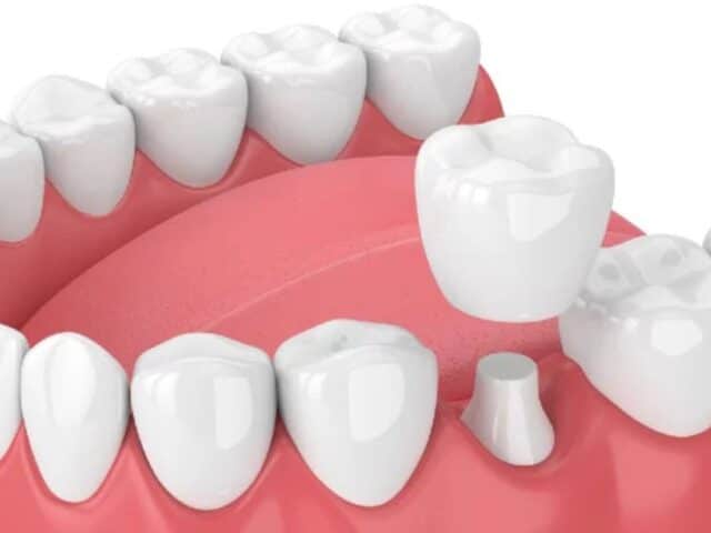 How Do Dental Crowns Work to Protect Your Teeth?