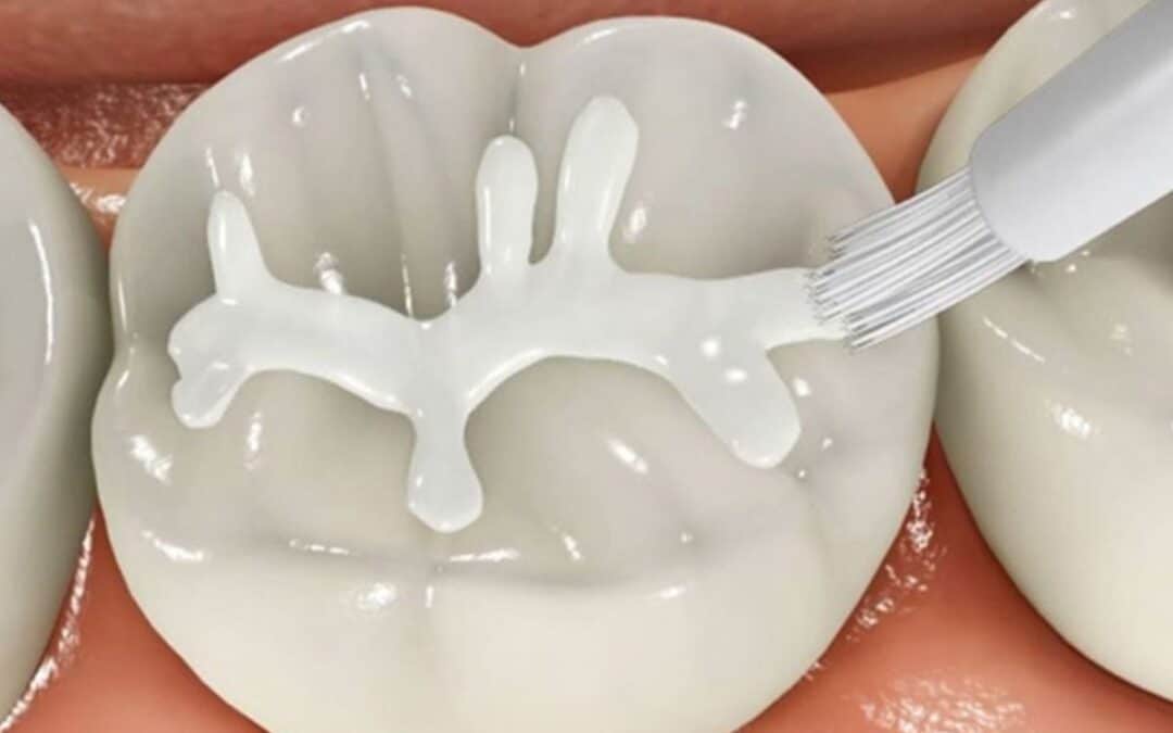 Are Dental Sealants Safe for Children and Adults?