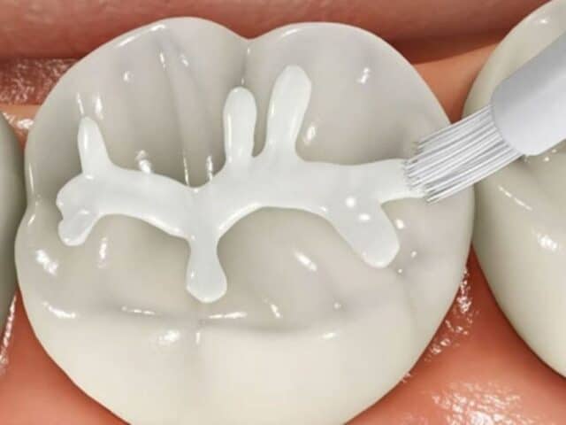 Are Dental Sealants Safe for Children and Adults?