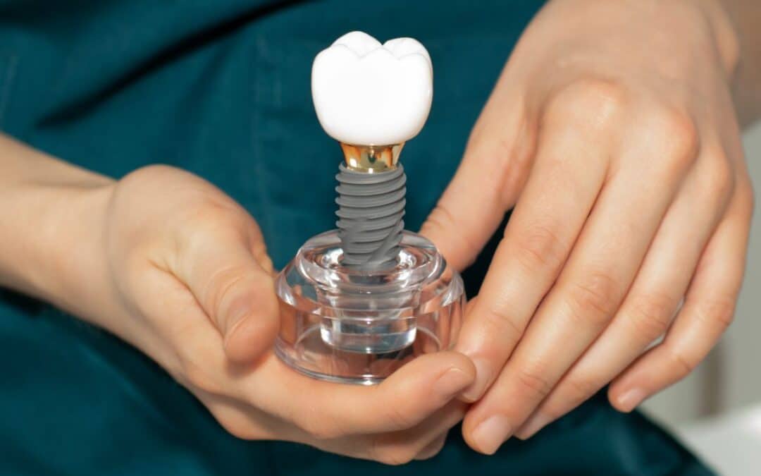 How to Clean and Care for Your Dental Implants