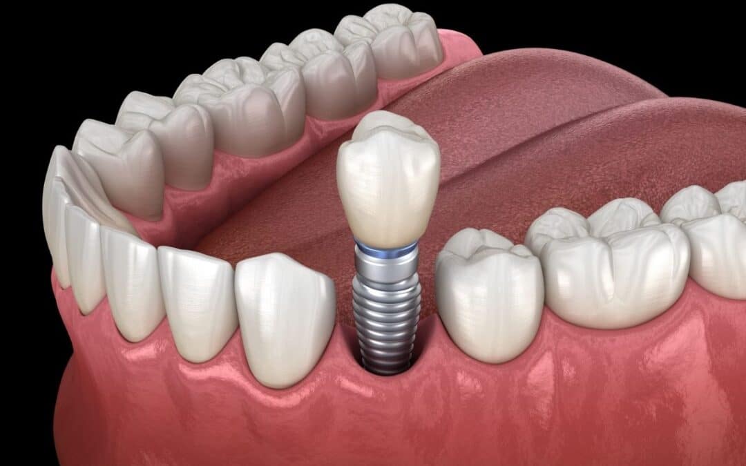What Hidden Health Factors Could Disqualify You from Implants?