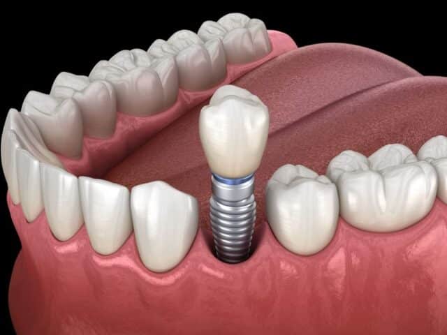 What Hidden Health Factors Could Disqualify You from Implants?