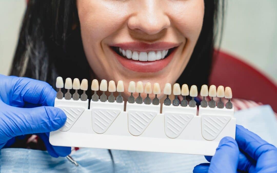 Can You Get Veneers If You Have Bruxism?