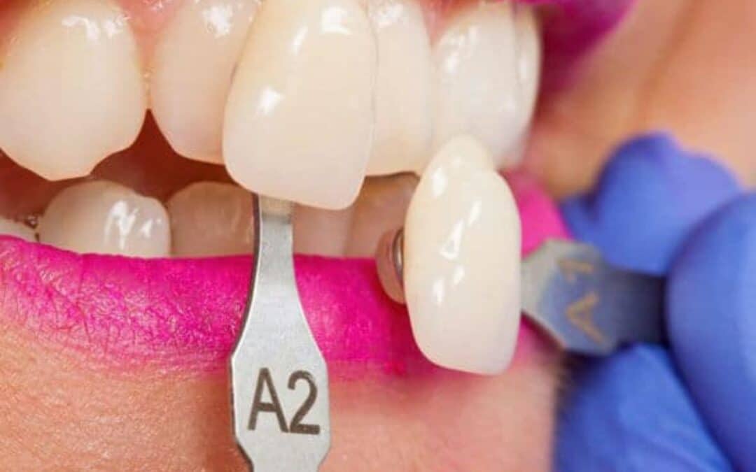 How Do Veneers Fix Discolored Teeth?