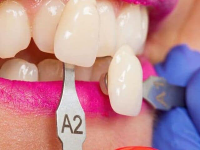 How Do Veneers Fix Discolored Teeth?