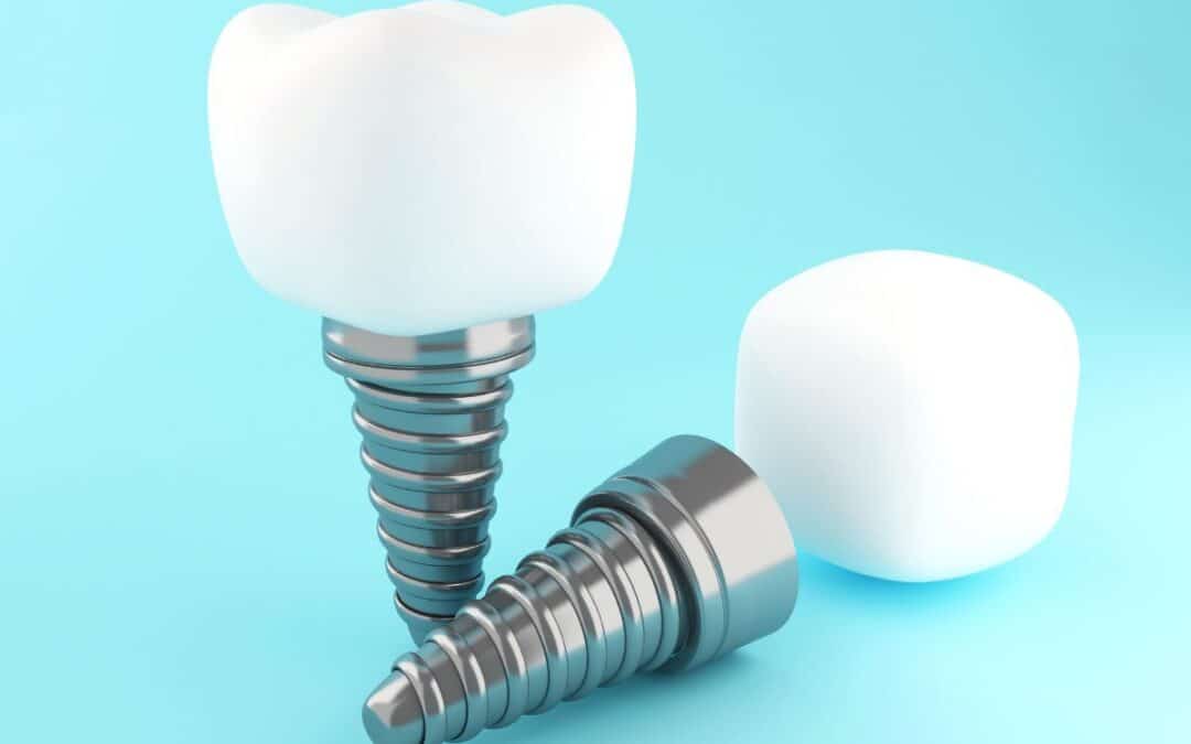 The Link Between Dental Implants and Overall Health