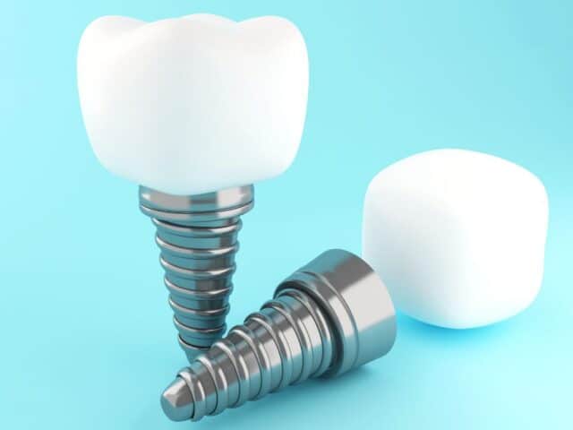 The Link Between Dental Implants and Overall Health