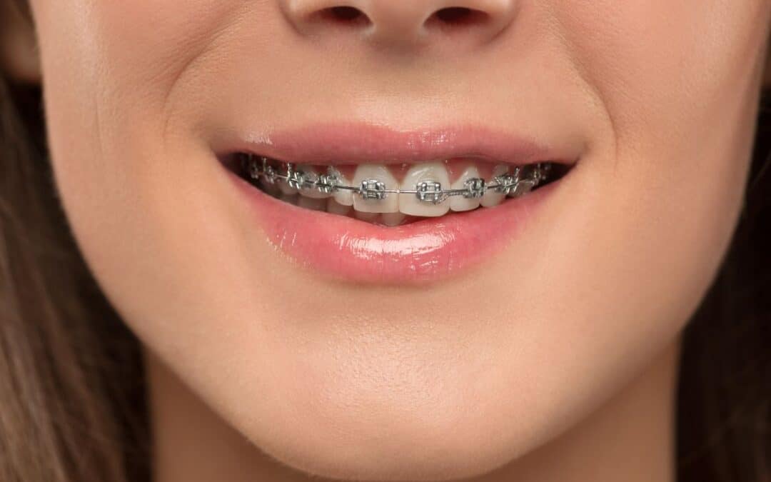 How Often Do Braces Need to Be Tightened and Adjusted?