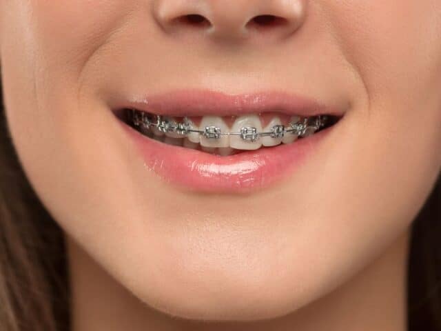 How Often Do Braces Need to Be Tightened and Adjusted?