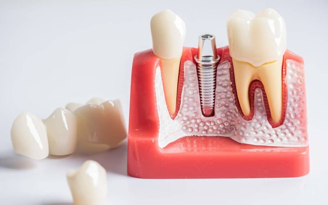 How Dental Implants Integrate with Jawbone Health