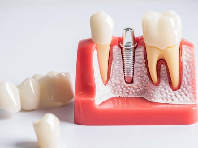 How Dental Implants Integrate with Jawbone Health
