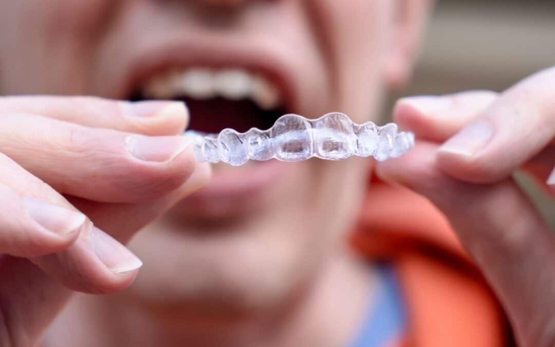 How Does Invisalign Work on Crowded Teeth?